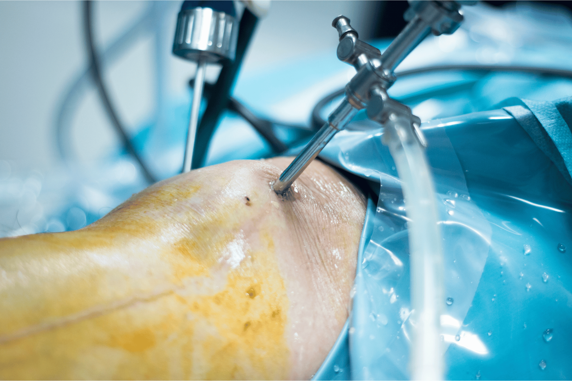 arthroscopic surgery shoulder