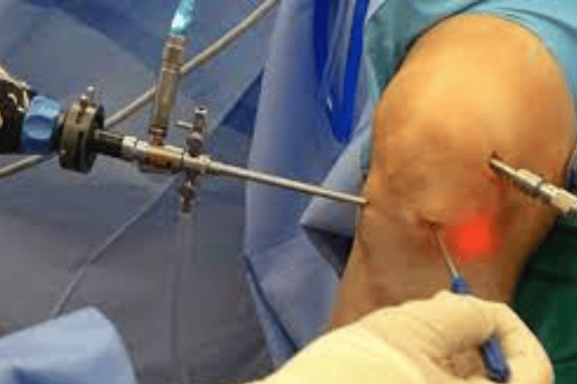 shoulder arthroscopy procedure