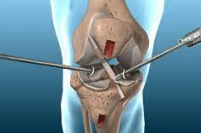 surgical arthroscopy