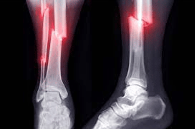 best knee replacement surgeon in pune