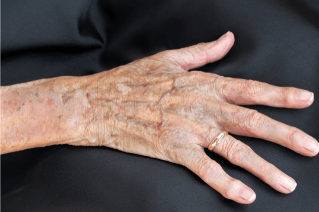 extreme foot callus removal